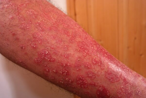 psoriasis 356429 1920